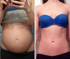 Antes e depois — redução do inchaço abdominal com Balance